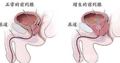 前列腺肥大是怎么引起的